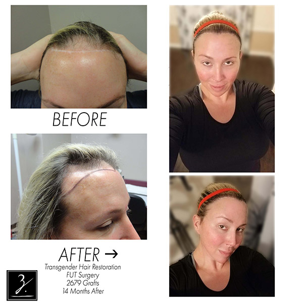 Transgender Hair Transplant Before and After Photos - Foundation For Hair  Restoration