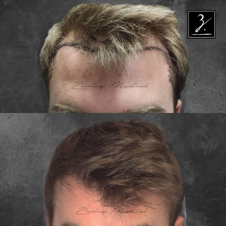 Male Hair Transplant Before and After Photos Ziering Medical