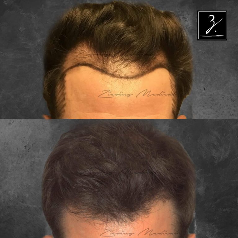 Male Hair Transplant Before and After Photos Ziering Medical