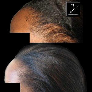 Female-Hair-Transplant-Beverly-Hills-African-American-3-1