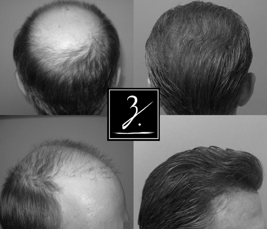 Hair Loss Solutions For Men | Control Your Hair Loss | Ziering Medical
