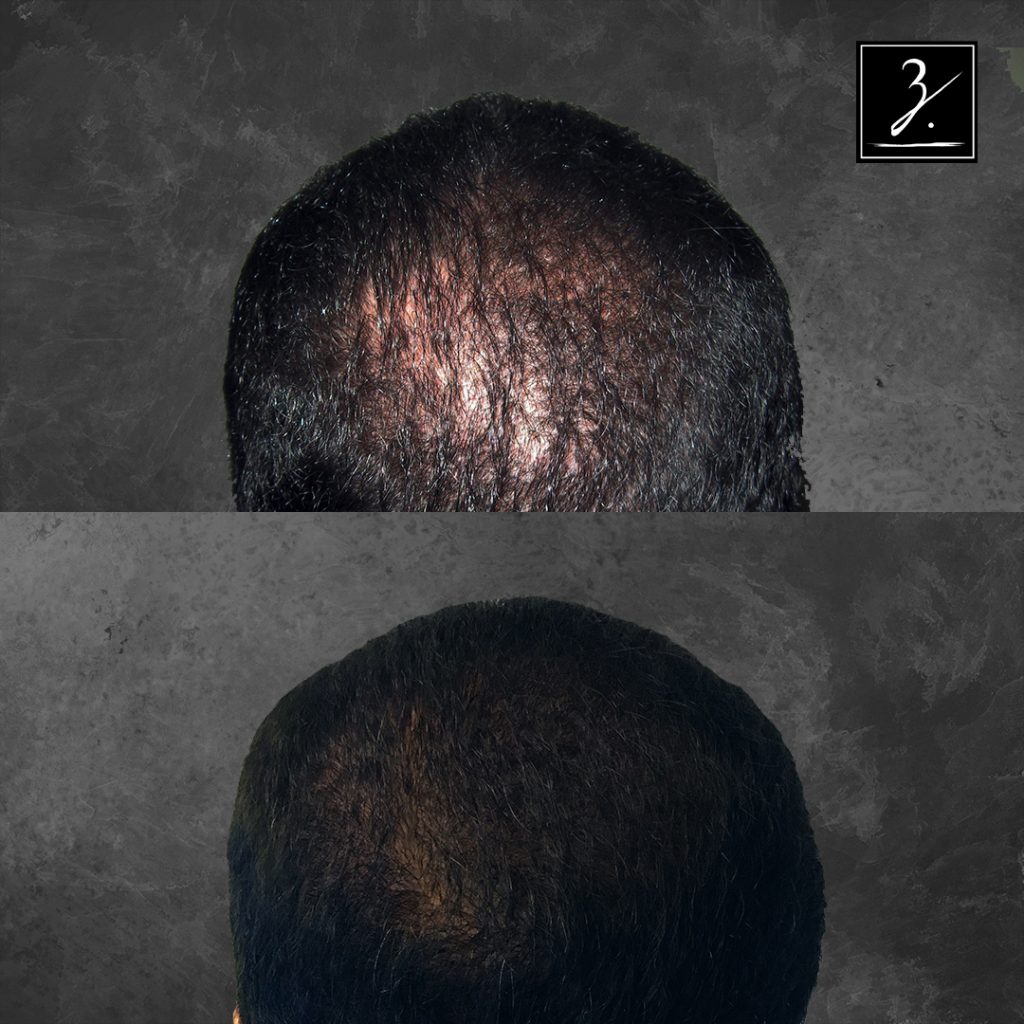 ziering_before-and-after_male-hair-transplant_1_C