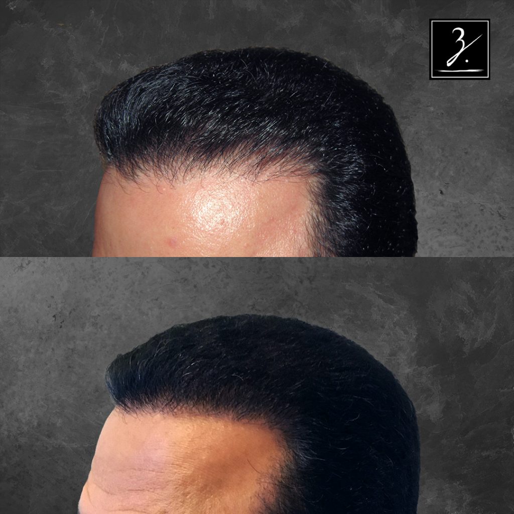 ziering_before-and-after_male-hair-transplant_1_F