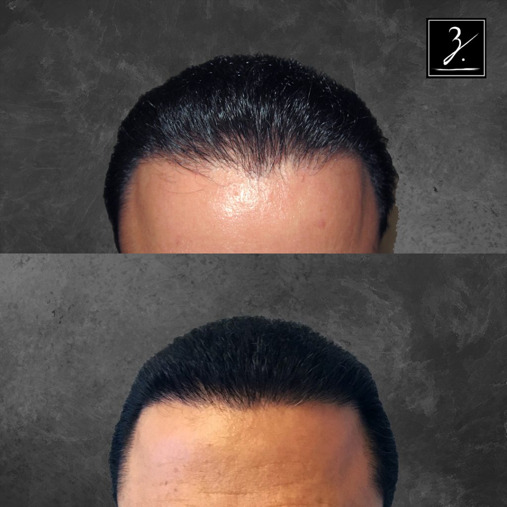 ziering_before-and-after_male-hair-transplant_1_ff