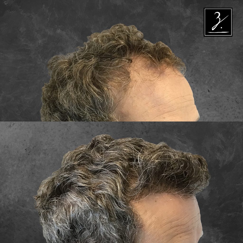 3,200 Follicular Units, 1 MDEE Hair Transplants, Showing Pre-Op Photos and 12 Months Post-Op