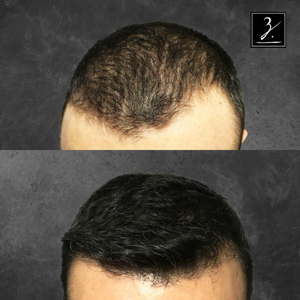 Male Hair Transplant Before and After Photos Ziering Medical