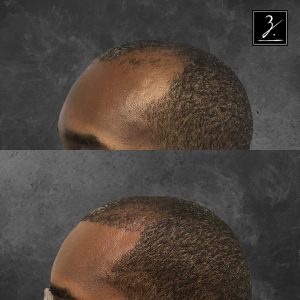 ziering_before-and-after_male-hair-transplant_5_45