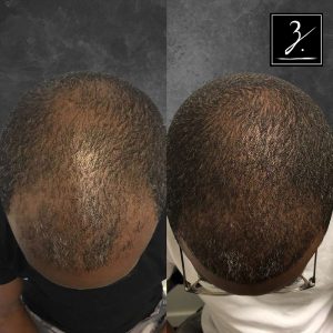 ziering_before-and-after_male-hair-transplant_5_C_2