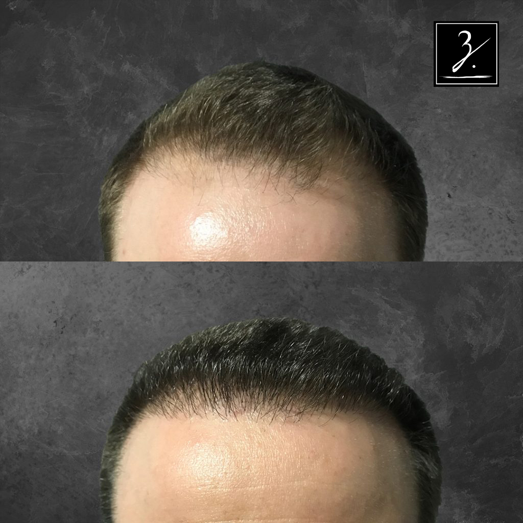 ziering_before-and-after_male-hair-transplant_8_F-1024x1024