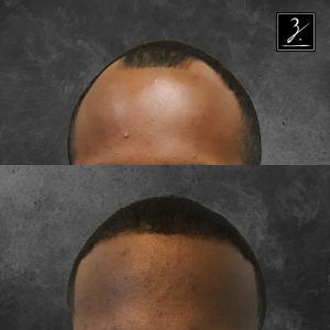 ziering_before-and-after_male-hair-transplant_9_F
