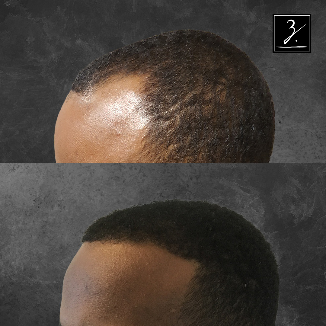 ziering_before-and-after_male-hair-transplant_9_FL-45-(1)