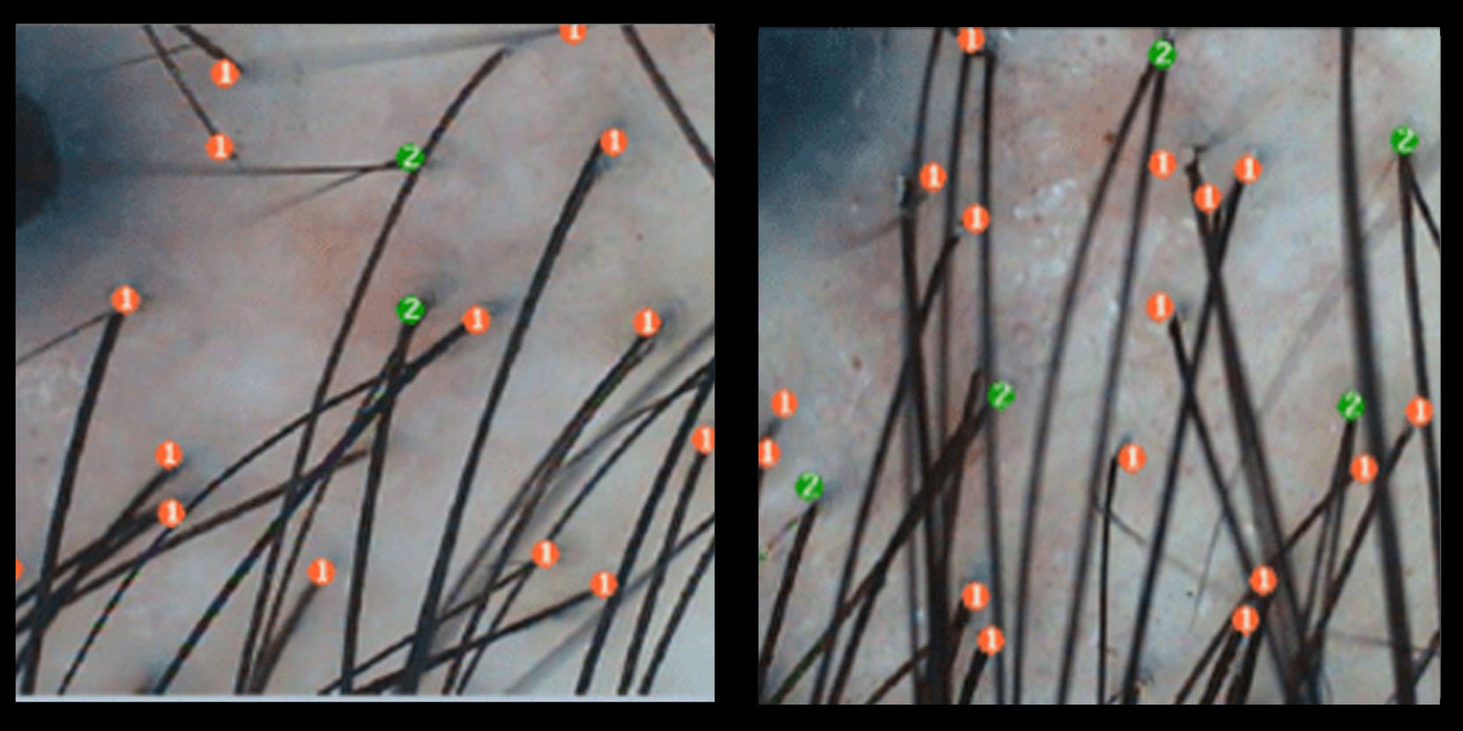 Keralase Treatment in New York Ziering Medical