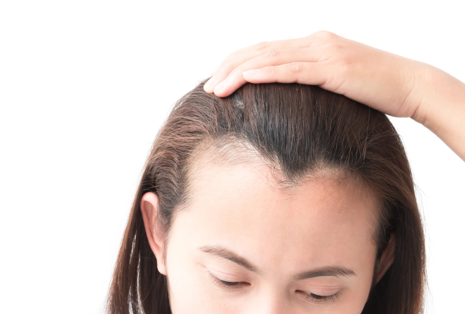 Are Transplanted Hairs Really Resistant To DHT? - Hair Transplant