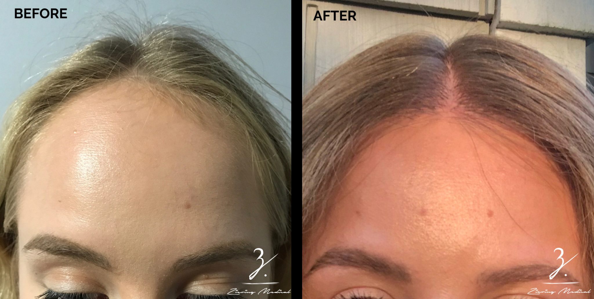 All You Need to Know About Hairline Lowering Surgery