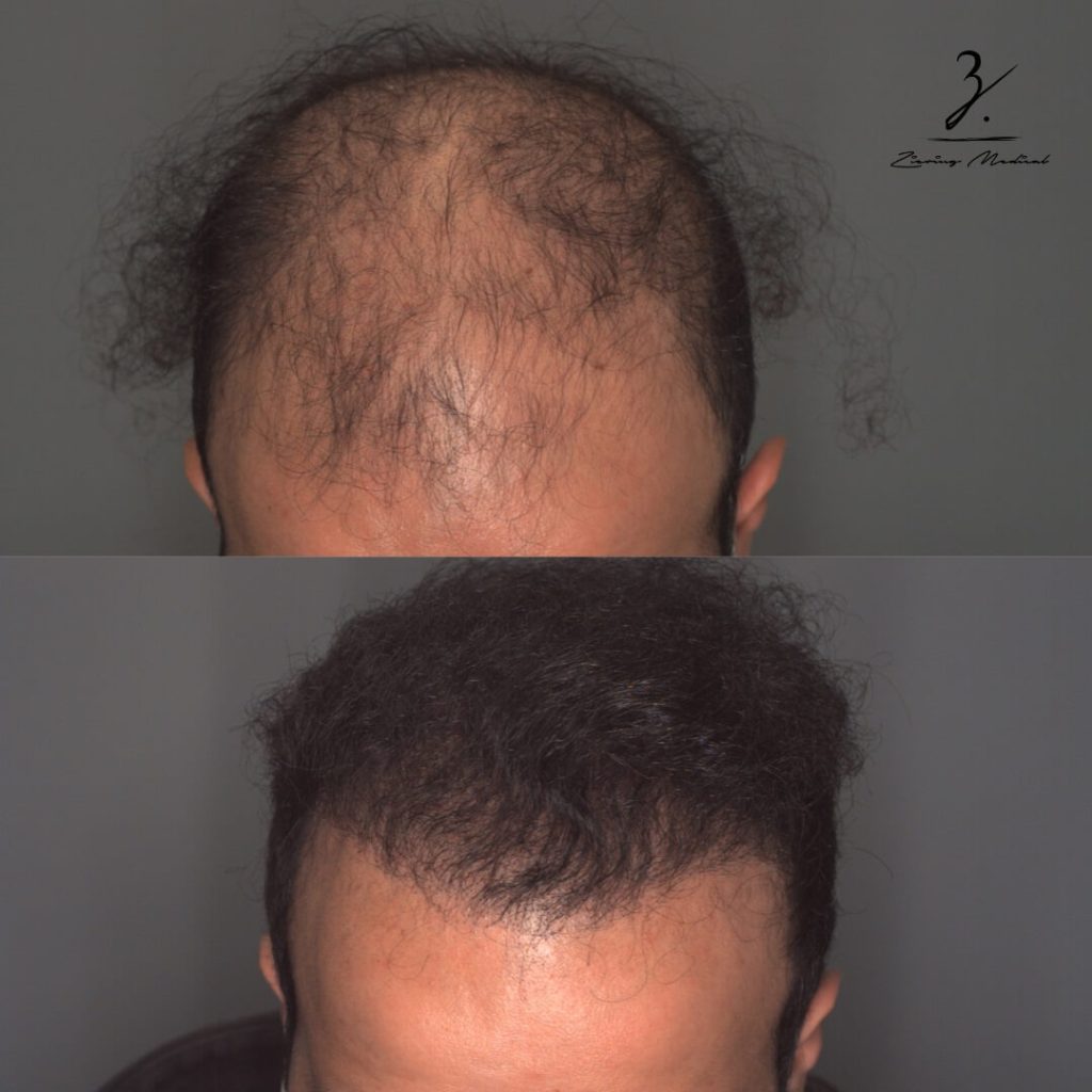 Male Hair Transplant Before and After Photos Ziering Medical