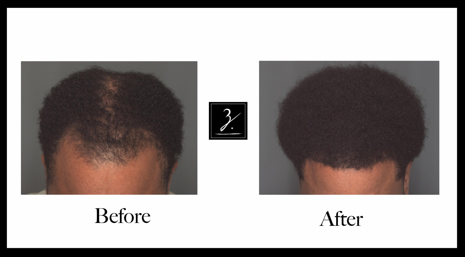 African American Hair Transplant Photos Ziering Medical