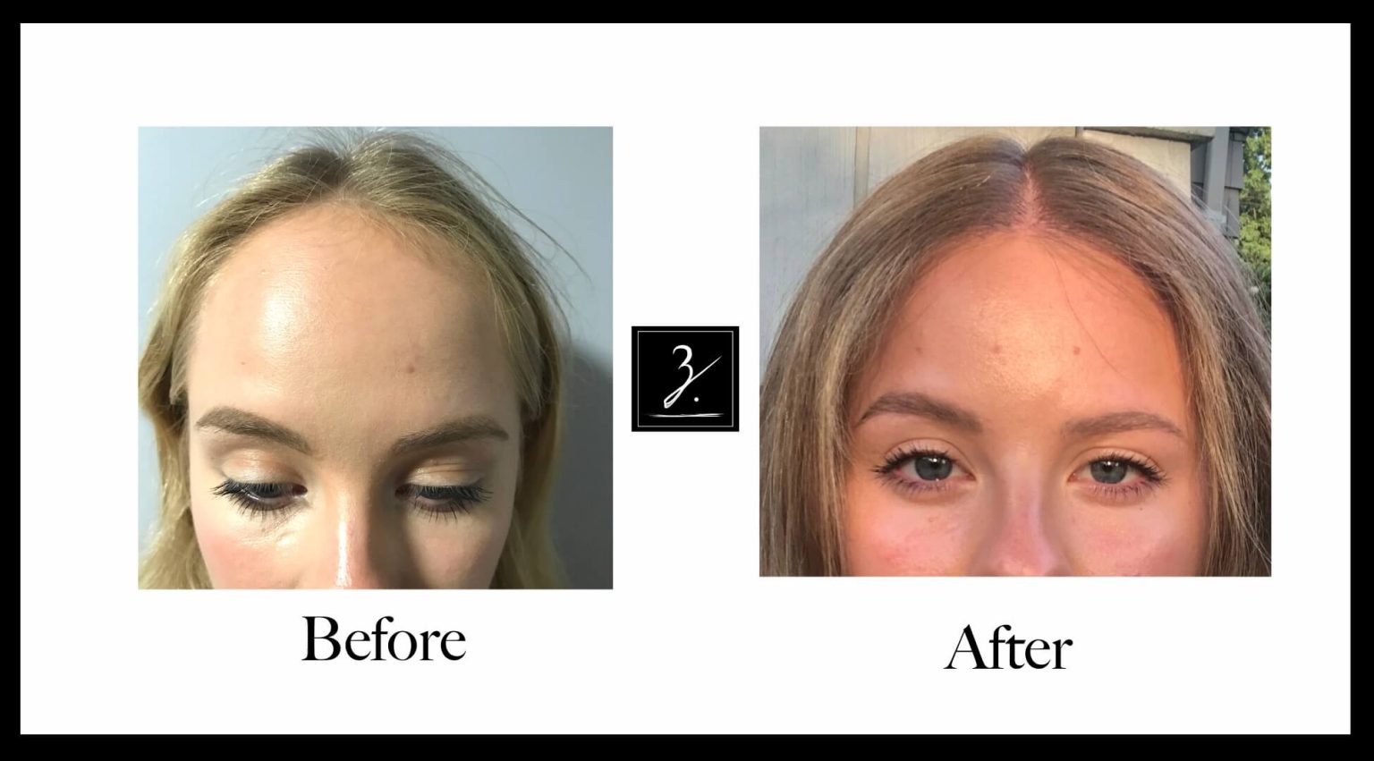 Female Hair Transplant Land Ziering Medical Get Appointment Now!