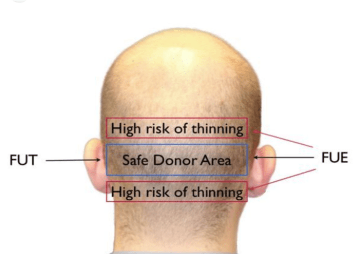 Read more about the article When More Isn’t Better:  The Consequences of Overharvesting Donor Hair in Hair Transplants