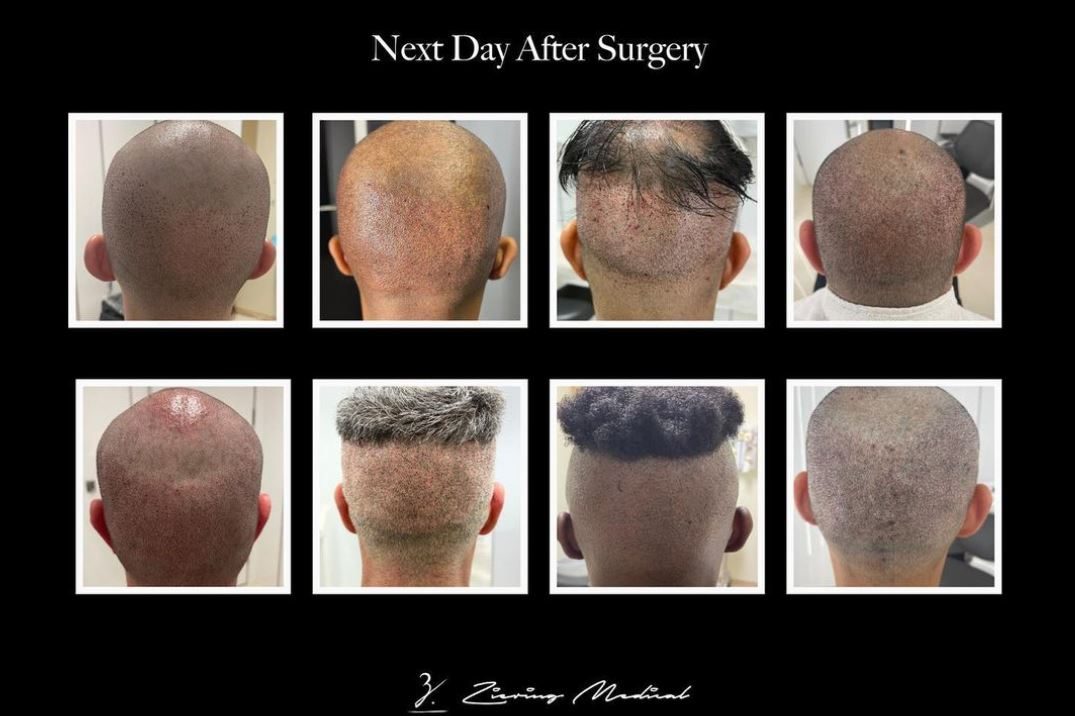 Read more about the article Complete Guide to Hair Transplant Growth and Recovery Timeline