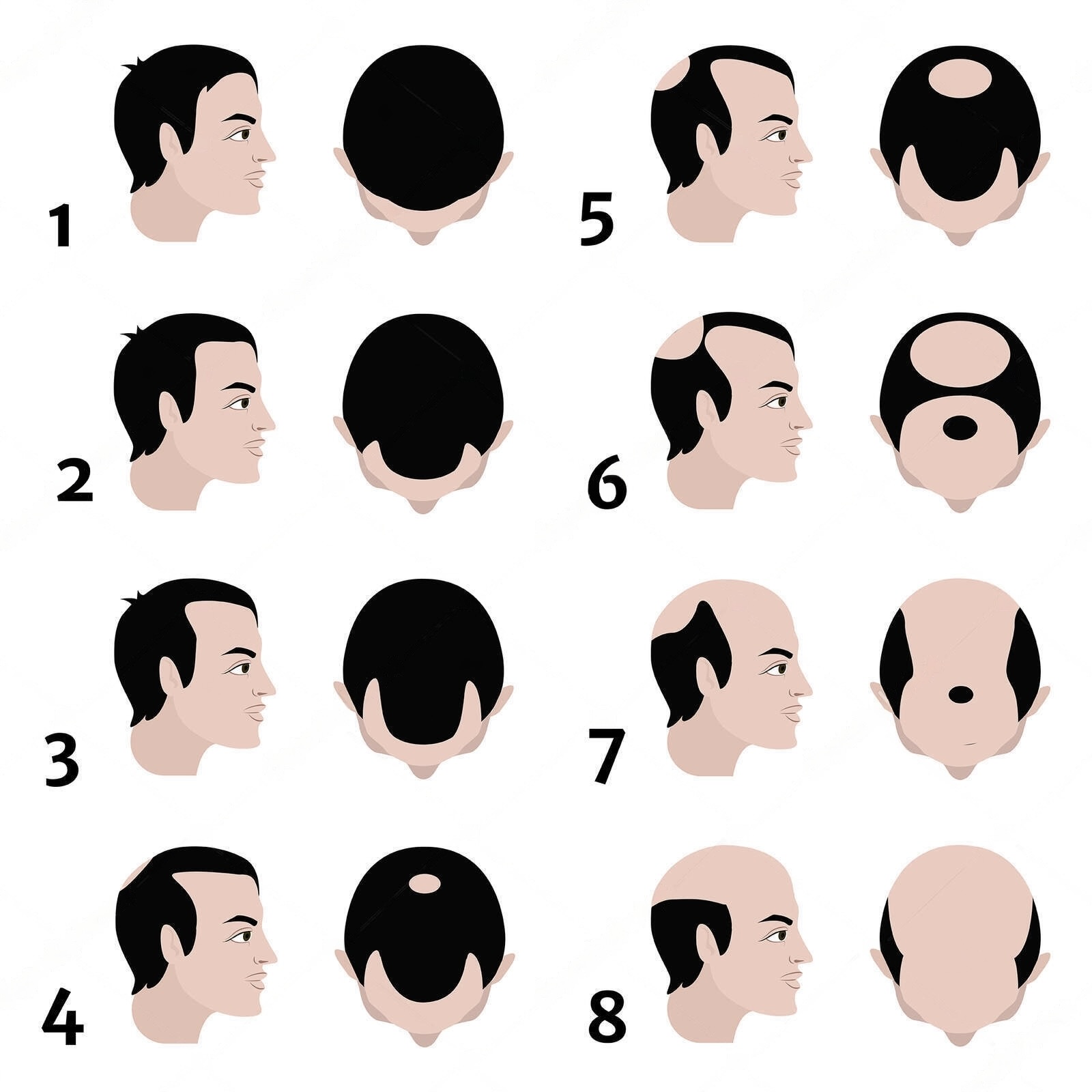 Read more about the article Hair Loss and You: How to Cope with Hair Loss and Ways to Stop It