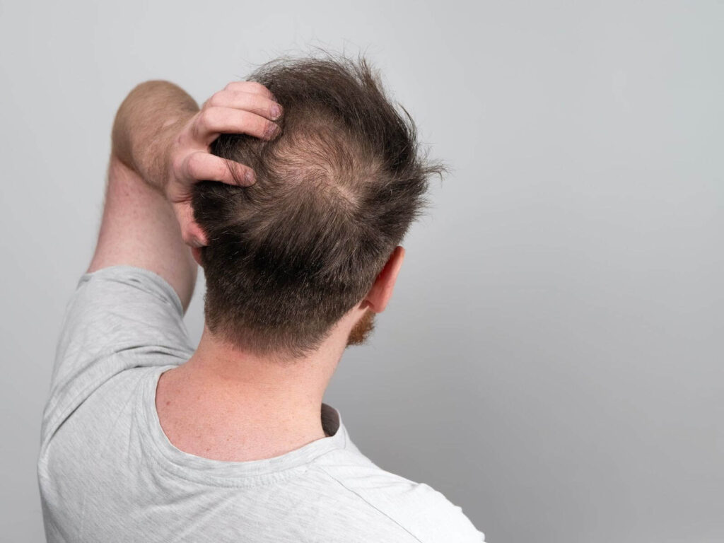 Read more about the article What is a FUE Hair Transplant? [Complete Guide 2024]