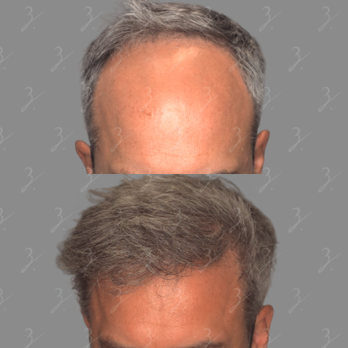Before and after images of a male with gray hair showcasing hair restoration results. The top image displays a receding hairline and thinning hair, while the bottom image demonstrates fuller hair with improved coverage and a more youthful appearance. Both images feature a neutral gray background, emphasizing the contrast in hair density and style. This visual representation highlights the effectiveness of hair restoration treatments for individuals experiencing hair loss.