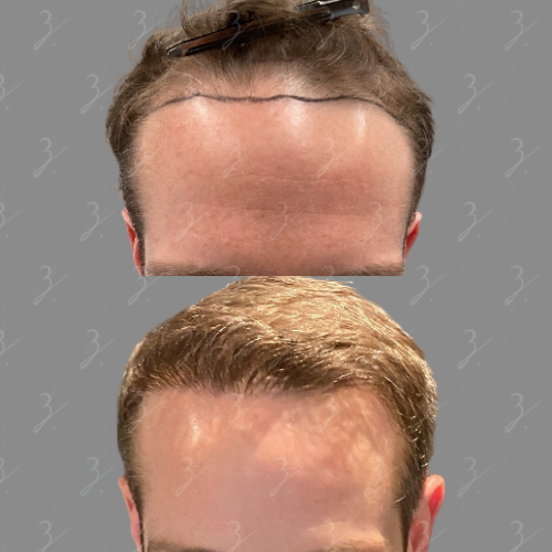 Before and after images of a hair restoration treatment, showcasing the transformation of a man's hairline. The top image displays the initial state with a prominent forehead and marked hairline, while the bottom image reveals the results post-treatment, featuring a fuller and more natural-looking hairline. This visual representation highlights the effectiveness of hair restoration procedures for individuals experiencing hair loss.