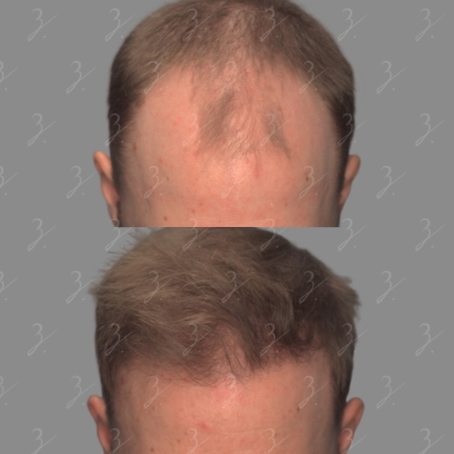 Before and after comparison of a male's hair restoration results, showcasing a noticeable improvement in hair density and coverage. The top image displays thinning hair and a receding hairline, while the bottom image reveals fuller hair with enhanced volume and a more youthful appearance. This visual demonstrates the effectiveness of hair restoration treatments for men experiencing hair loss. Ideal for individuals seeking solutions for male pattern baldness or hair thinning.