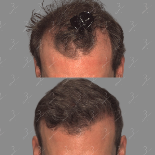 Image of a man’s hair before and after styling, showing the top view. The top section displays unruly hair held in place with a black hair clip, while the bottom section presents a neatly styled hairstyle. The background is a neutral gray, emphasizing the hair transformation. This image illustrates hair styling techniques and product effectiveness for achieving a polished look. Ideal for articles about men's grooming, hairstyling tips, or product reviews.