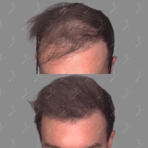 Before and after images of a male's hair restoration treatment, showcasing the transformation from thinning hair on the top image to a fuller hair appearance in the bottom image. The images highlight the effectiveness of the treatment in addressing hair loss, emphasizing the improvement in hair density and overall look. The background is neutral gray, ensuring focus on the hair changes. This visual representation is relevant for individuals seeking solutions for hair thinning or loss.