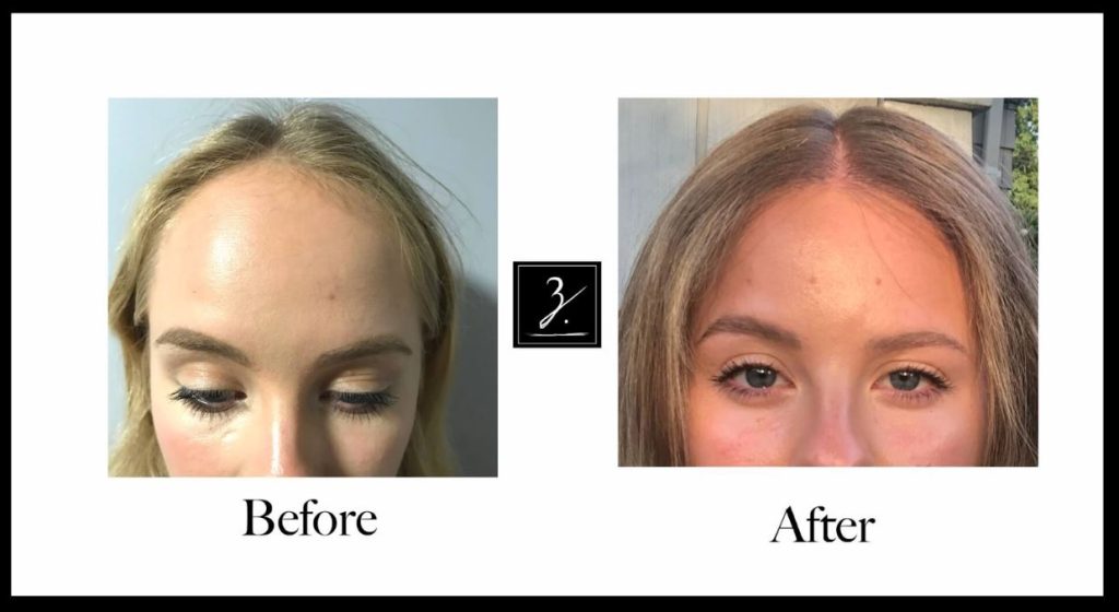 Before and after images showcasing a hair transformation. The left side displays the "Before" look with lighter, less voluminous hair, while the right side shows the "After" result with fuller, healthier hair. Both photos focus on the individual's face, highlighting the change in hair texture and color. The images emphasize the effectiveness of the hair treatment, making it clear that the transformation enhances the overall appearance. Ideal for those seeking inspiration for hair improvements or treatments.