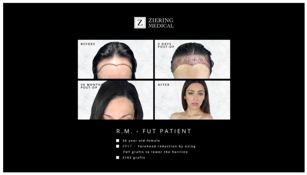 Before and after images of a 36-year-old female patient, R.M., showcasing her forehead reduction surgery using follicular unit transplantation (FUT). The top-left image displays her hairline before the procedure, while the top-right shows her scalp three days post-operation with visible healing. The bottom-left image captures her hairline 20 months after surgery, highlighting significant improvement. The bottom-right image features R.M. after the procedure, demonstrating the successful results of lowering her hairline with a total of
