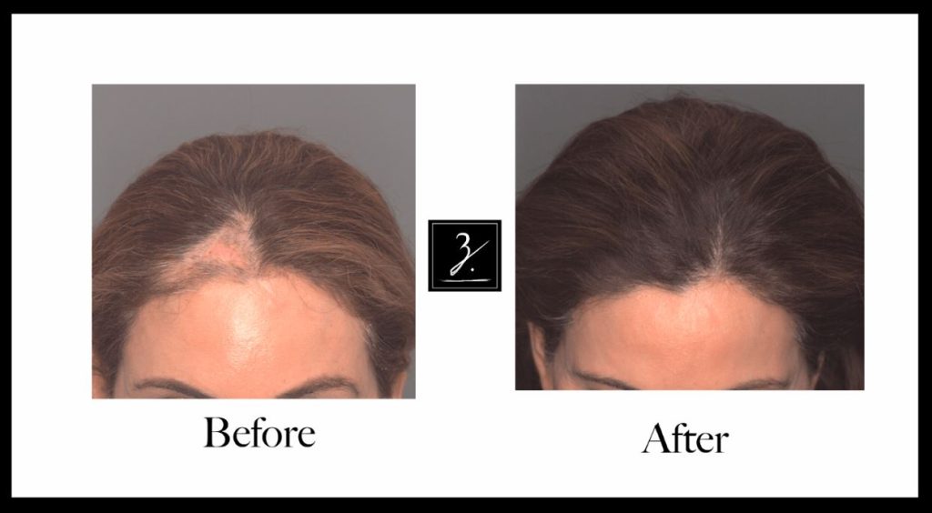 Before and after images showcasing hair restoration results. The left side displays the individual's hairline before treatment, highlighting thinning areas and a receding hairline. The right side shows the improved hairline after the treatment, demonstrating fuller and healthier-looking hair. This visual comparison emphasizes the effectiveness of the hair restoration procedure, appealing to potential clients seeking similar results.