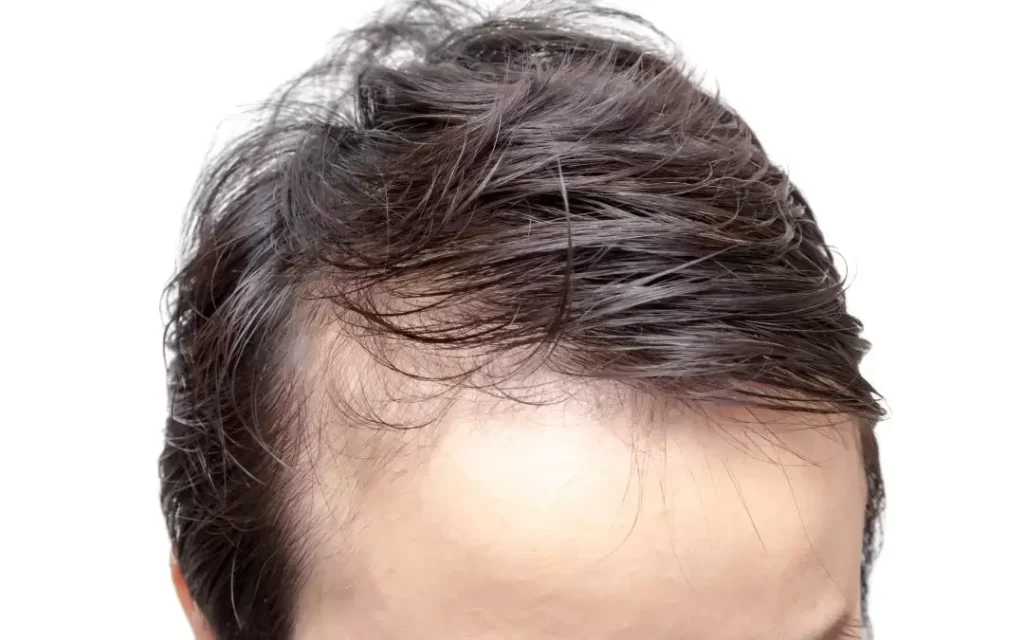 Close-up image of a man's hairline showing thinning hair and a receding forehead. The photograph captures the texture of the hair, highlighting the contrast between the fuller hair and the areas of thinning. This image is relevant for discussions on male pattern baldness, hair loss treatments, and hairstyling options for thinning hair. The background is plain white, ensuring the focus remains on the hair and scalp condition. This visual serves as a resource for individuals seeking information on hair health and styling alternatives for those experiencing