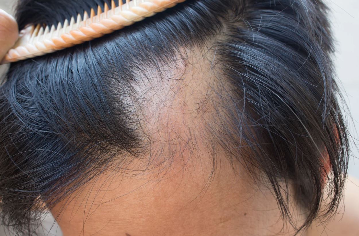 Read more about the article What Hormone Causes Women’s Hair Loss​? 