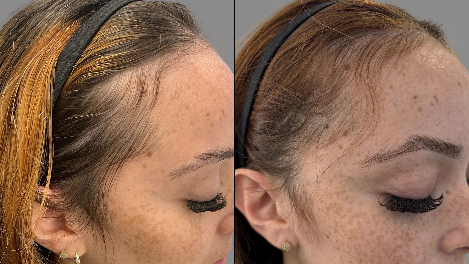 Female B&A