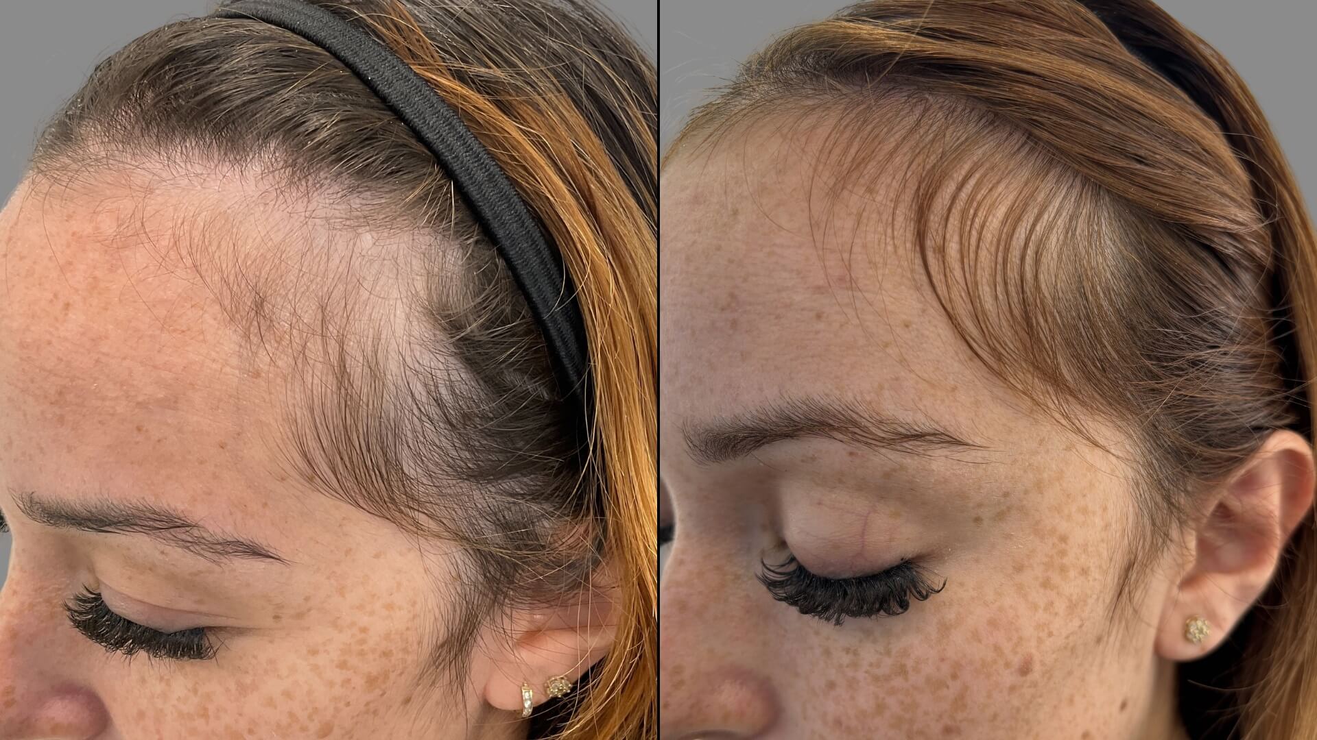 Female Left Profile B&A