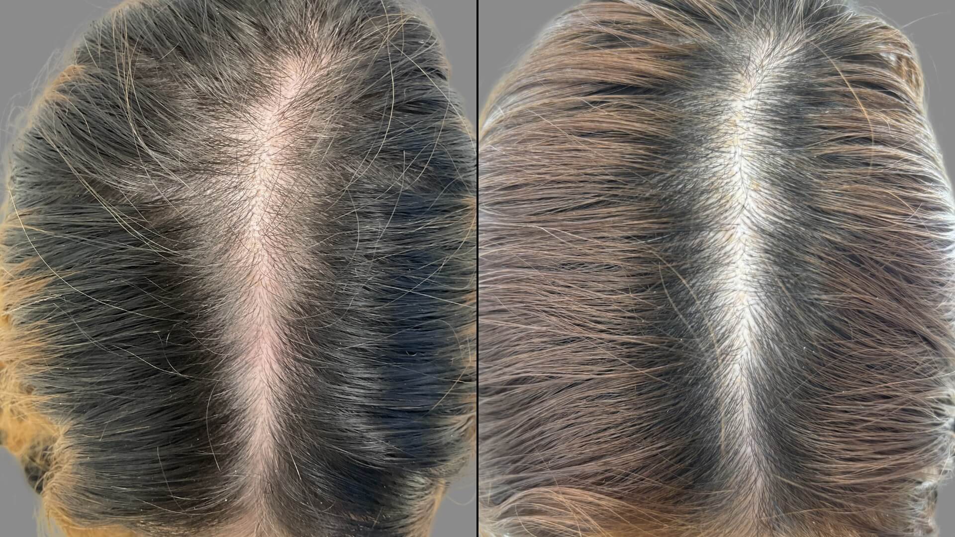 Female (Y) Top View B&A