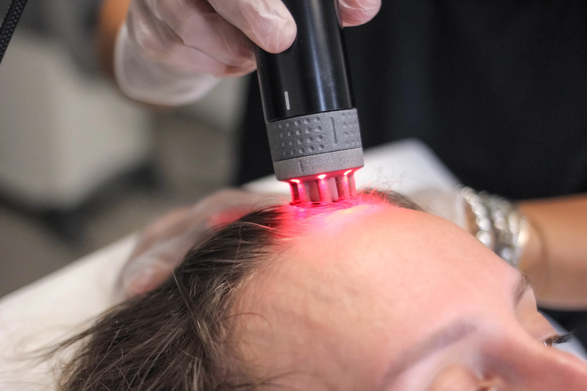 TRICOPAT® Session for a non-surgical hair restoration