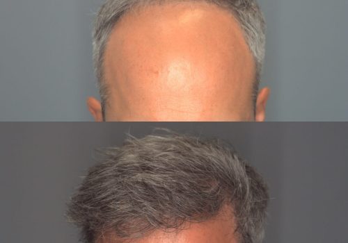 Before and after images showcasing a male's hair restoration results. The top image displays a receding hairline with thinning hair, while the bottom image highlights fuller, thicker hair after treatment. This visual demonstrates the effectiveness of hair restoration techniques for improving hair density and overall appearance. Ideal for individuals considering hair restoration options, this image emphasizes the transformation and potential benefits of the procedure.