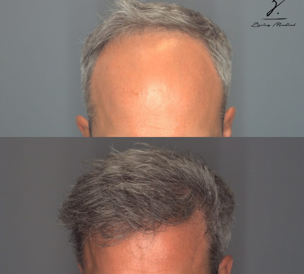 Before and after images showcasing a male's hair restoration results. The top image displays a receding hairline with thinning hair, while the bottom image highlights fuller, thicker hair after treatment. This visual demonstrates the effectiveness of hair restoration techniques for improving hair density and overall appearance. Ideal for individuals considering hair restoration options, this image emphasizes the transformation and potential benefits of the procedure.
