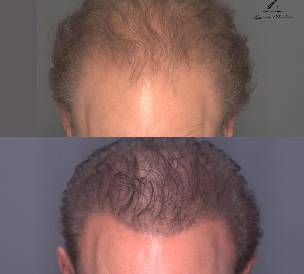 Before and after images of a hair restoration treatment showing significant improvement in hair density and coverage. The top image displays thinning hair with visible scalp, while the bottom image showcases fuller, thicker hair. This transformation highlights the effectiveness of modern hair restoration techniques for addressing hair loss and enhancing appearance. Ideal for individuals considering hair restoration options.