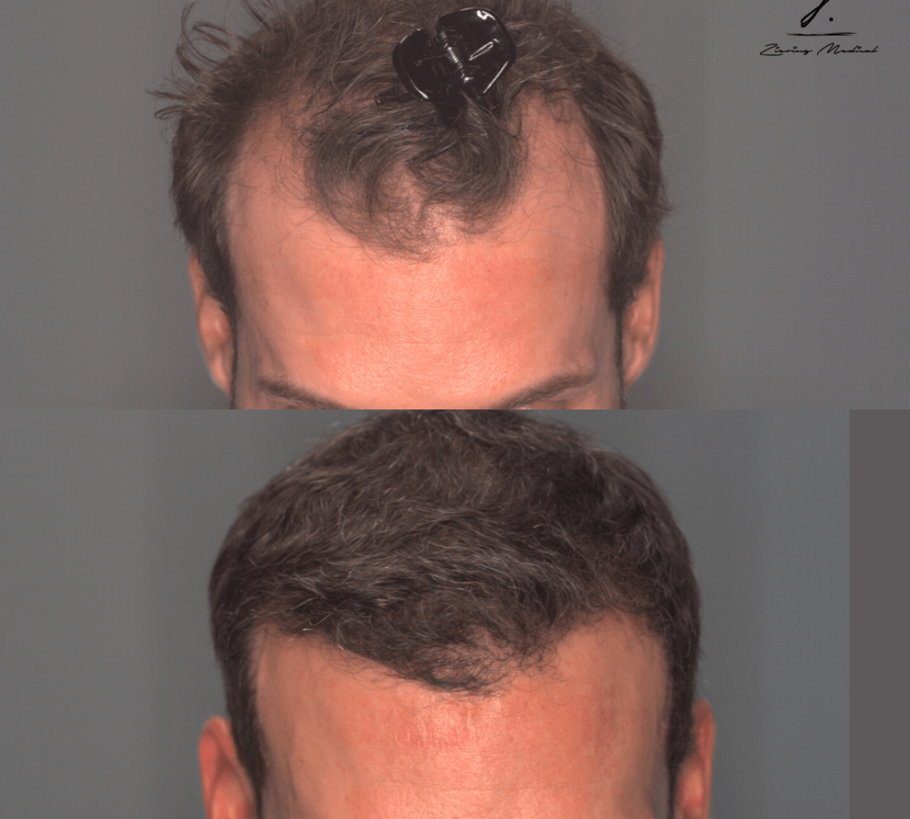 Before and after images of a male showing hair restoration results. The top image depicts thinning hair with a clip holding back unruly strands, while the bottom image showcases fuller, styled hair, highlighting the effectiveness of the hair restoration procedure. This visual contrast emphasizes the transformation and improvement in hair density and appearance, making it relevant for individuals considering hair restoration options.