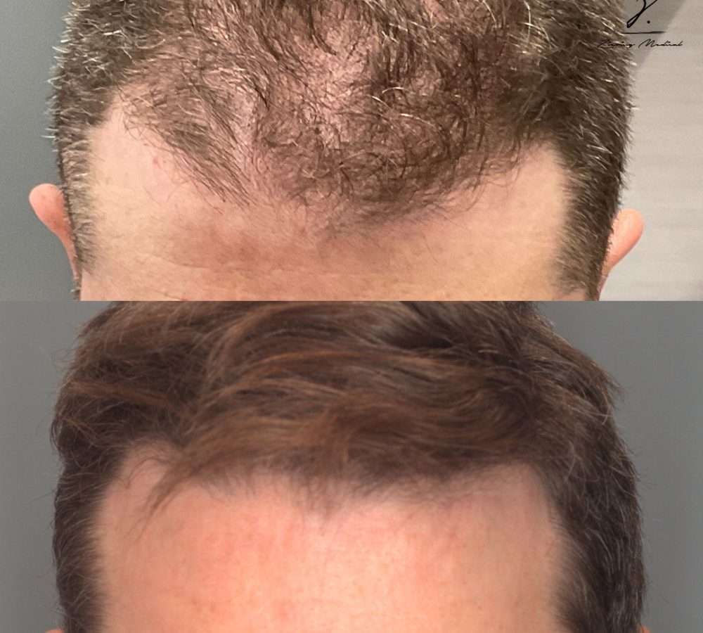 Before and after images showcasing hair restoration results. The top image displays thinning hair and a receding hairline, while the bottom image shows a fuller head of hair with improved density and style. This visual comparison highlights the effectiveness of hair transplant procedures, illustrating significant transformation and enhanced appearance. Ideal for individuals considering hair restoration options, this image emphasizes the potential benefits of treatment in combating hair loss.