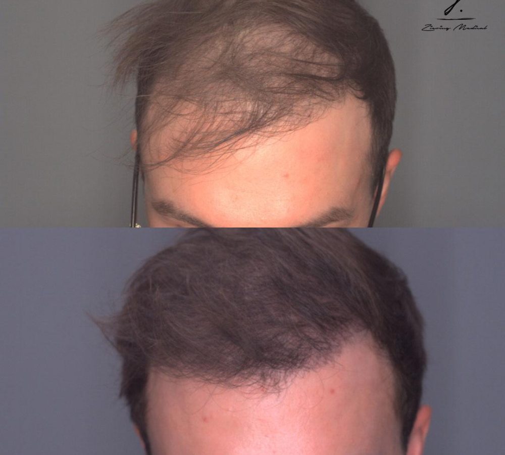 Before and after images of a hair restoration treatment, showing significant improvement in hair density. The top image displays thinning hair and a receding hairline, while the bottom image reveals a fuller, more youthful appearance with restored hair volume. This visual comparison highlights the effectiveness of hair restoration procedures for individuals experiencing hair loss. Ideal for those considering similar treatments, the images emphasize the potential results and benefits of professional hair restoration solutions.