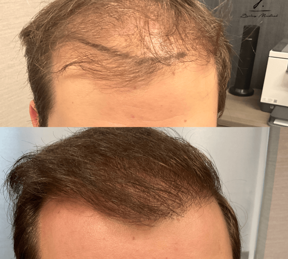 Before and after image showcasing hair restoration results. The top half displays thinning hair with noticeable bald spots, while the bottom half shows a fuller, healthier head of hair. This transformation highlights the effectiveness of hair restoration treatments, appealing to individuals seeking solutions for hair loss. The image emphasizes the positive impact of such treatments on personal appearance and confidence.