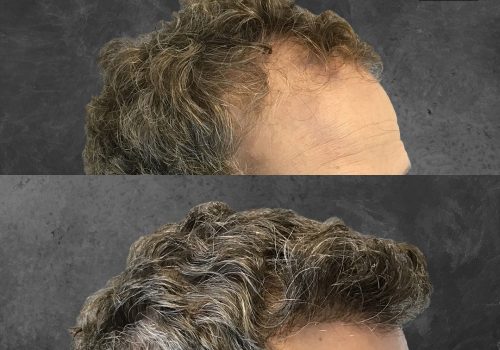 Before and after image showcasing a hair restoration treatment. The top section displays thinning hair with visible receding areas, while the bottom section illustrates a fuller, healthier hairstyle with increased volume and coverage. This transformation highlights the effectiveness of hair restoration solutions, appealing to individuals experiencing hair loss. The background is neutral to emphasize the hair changes, making it suitable for promotional use in hair restoration services.
