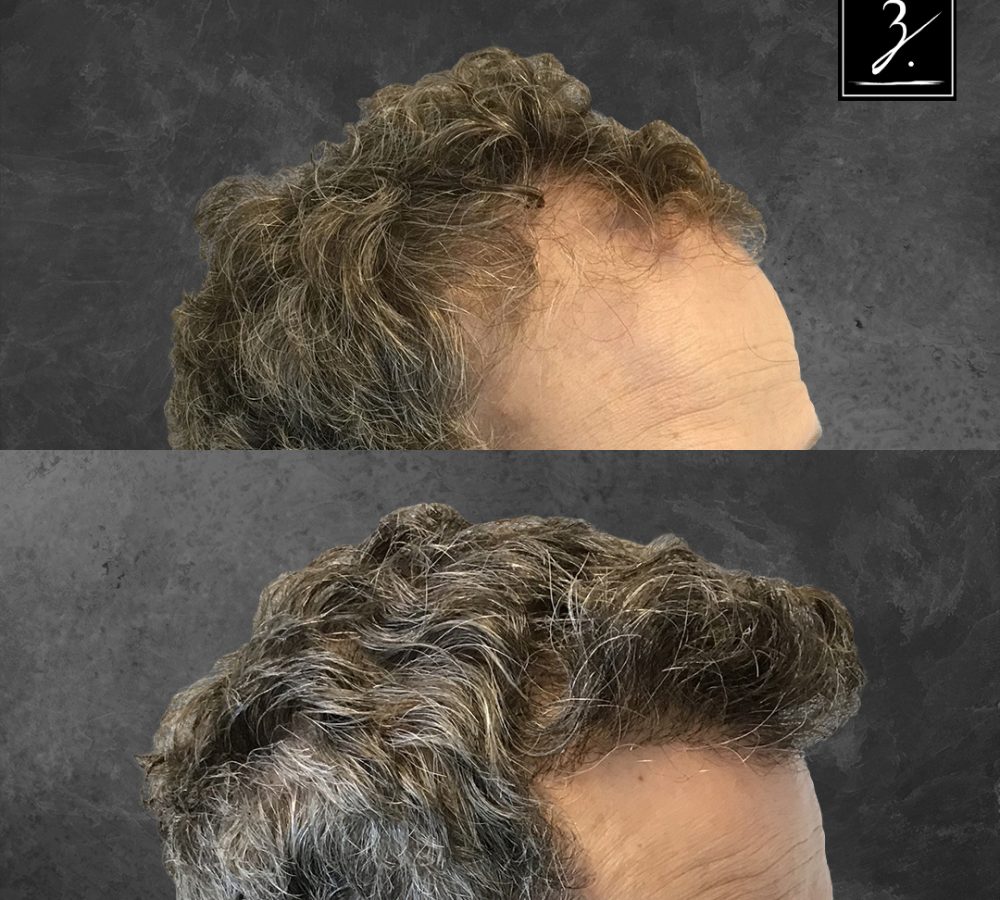 Before and after image showcasing a hair restoration treatment. The top section displays thinning hair with visible receding areas, while the bottom section illustrates a fuller, healthier hairstyle with increased volume and coverage. This transformation highlights the effectiveness of hair restoration solutions, appealing to individuals experiencing hair loss. The background is neutral to emphasize the hair changes, making it suitable for promotional use in hair restoration services.