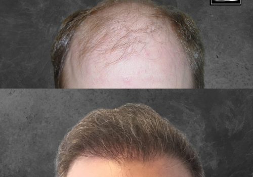 Before and after image showcasing hair restoration results. The top half displays a receding hairline with thinning hair, while the bottom half illustrates a fuller, thicker hairstyle after treatment. The background is a textured gray, emphasizing the contrast in hair density. This visual highlights the effectiveness of hair restoration solutions in improving appearance and confidence. Ideal for individuals considering hair loss treatments or seeking inspiration for their own hair transformation journey.