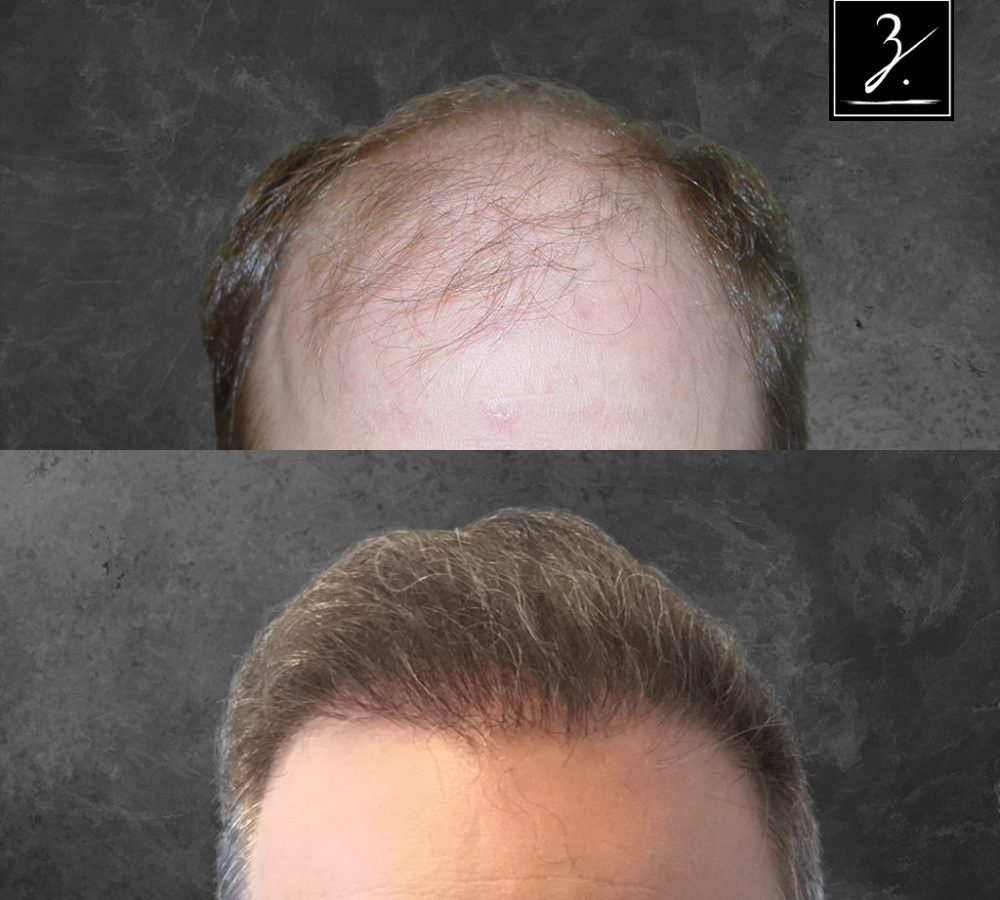 Before and after image showcasing hair restoration results. The top half displays a receding hairline with thinning hair, while the bottom half illustrates a fuller, thicker hairstyle after treatment. The background is a textured gray, emphasizing the contrast in hair density. This visual highlights the effectiveness of hair restoration solutions in improving appearance and confidence. Ideal for individuals considering hair loss treatments or seeking inspiration for their own hair transformation journey.